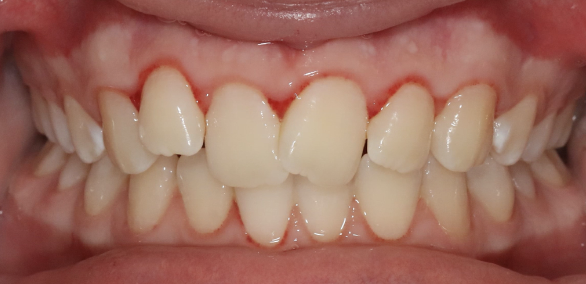 Aligner tray illustration